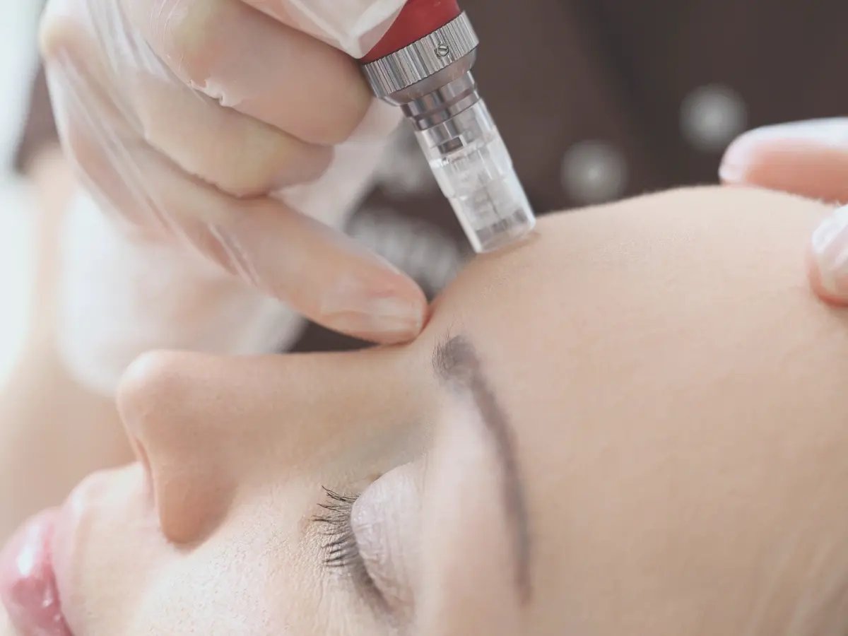 Collagen Induction Micro-needling Therapy (1)-1