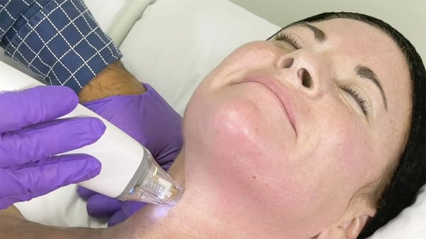 RF Microneedling on women's neck