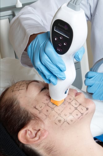 DLK_Thermage_Treatment_Face DLK_Thermage_Treatment_Face