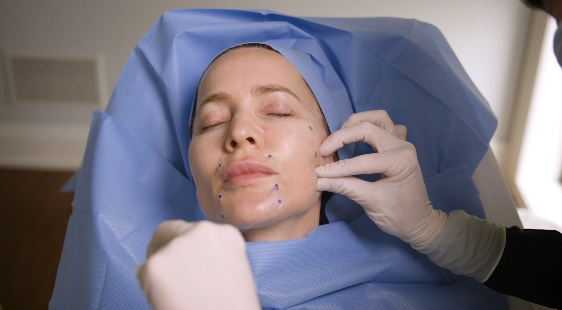 DLK_Thread_Lift_Treatment DLK_Thread_Lift_Treatment