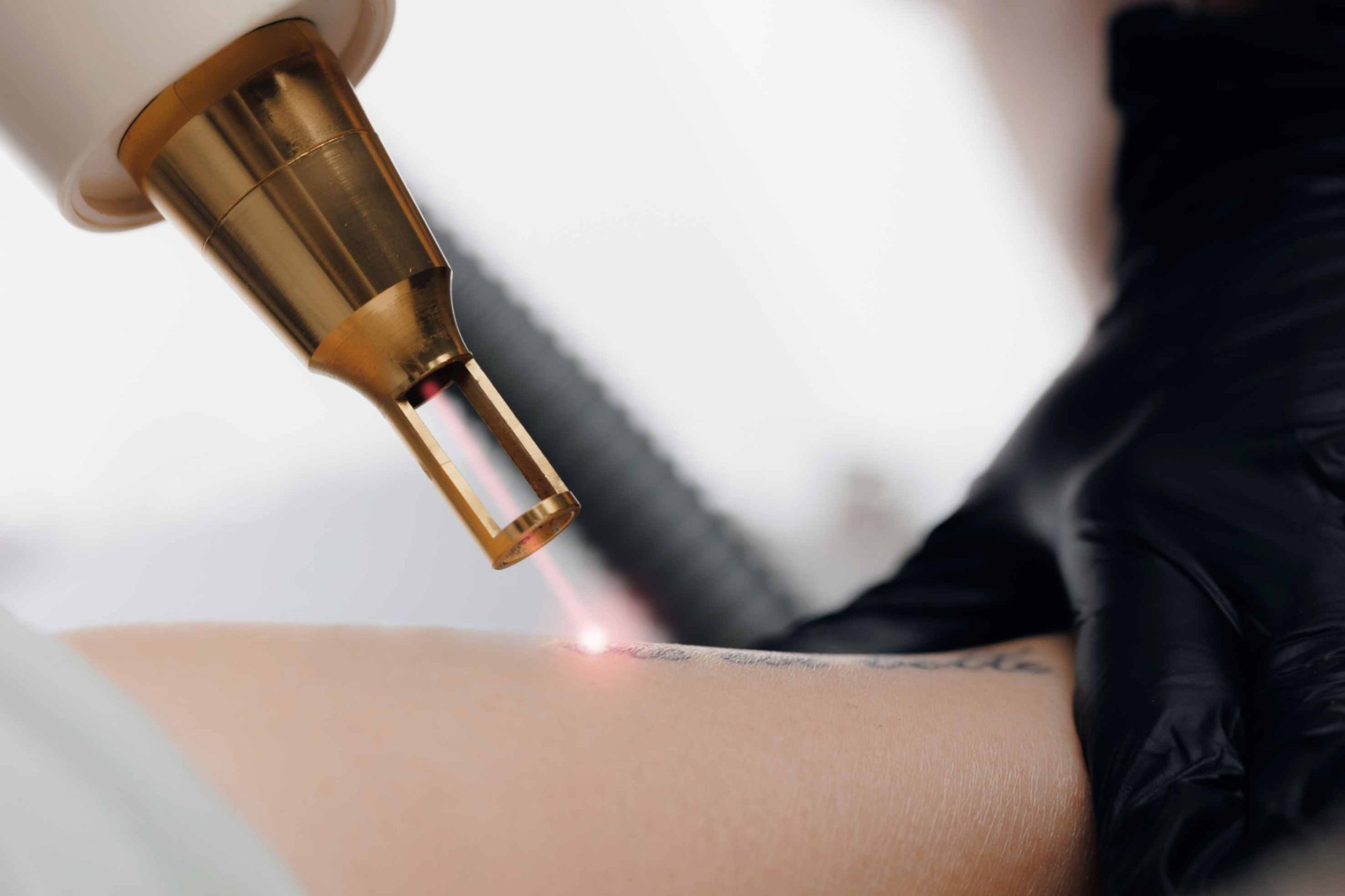 Laser Tattoo Removal