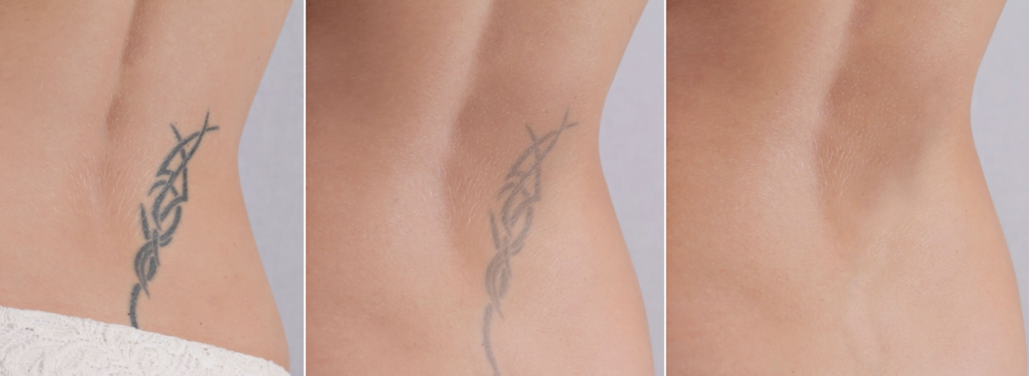 Laser Tattoo Removal