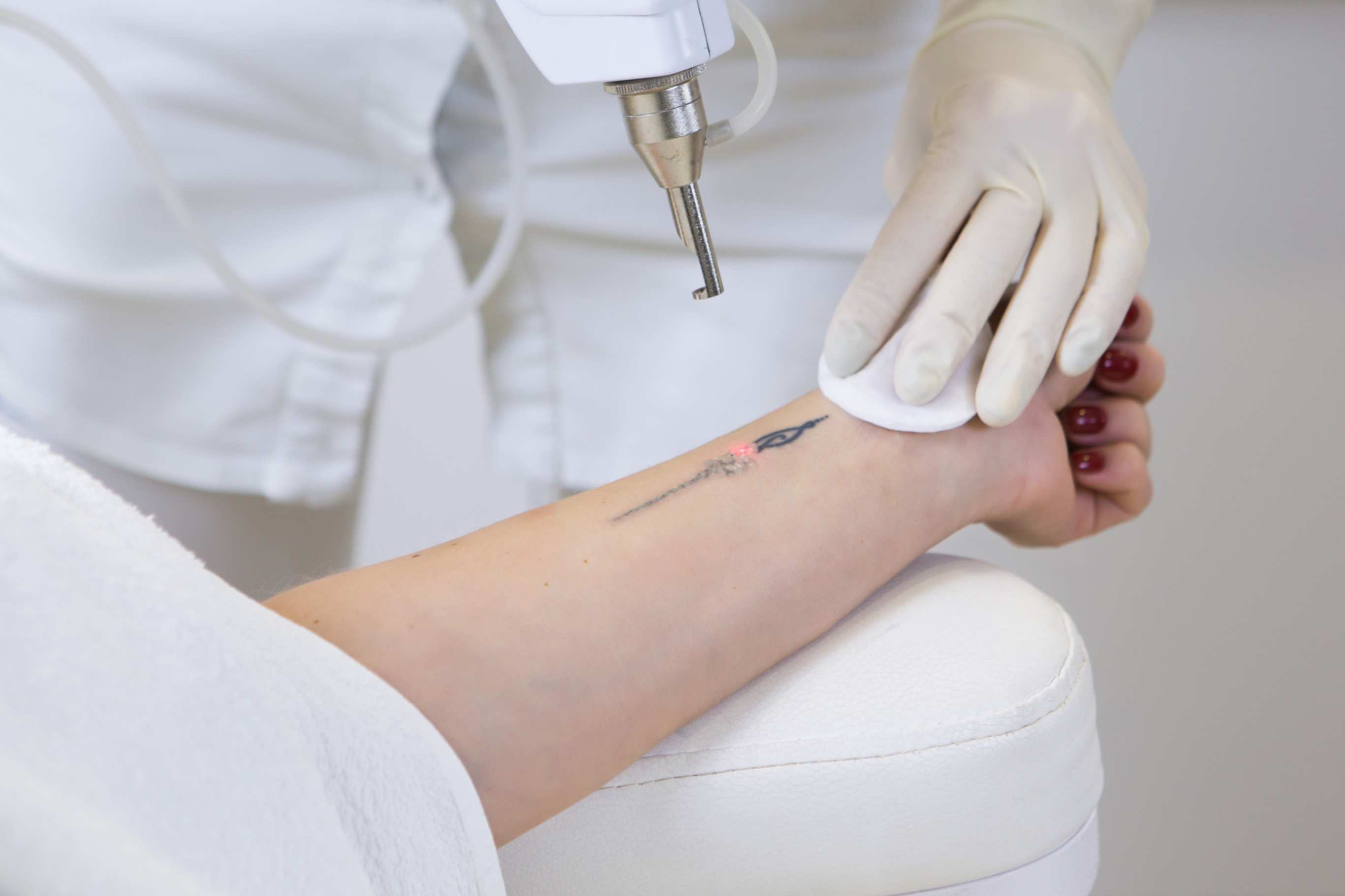 Laser_tattoo_removal_treatment