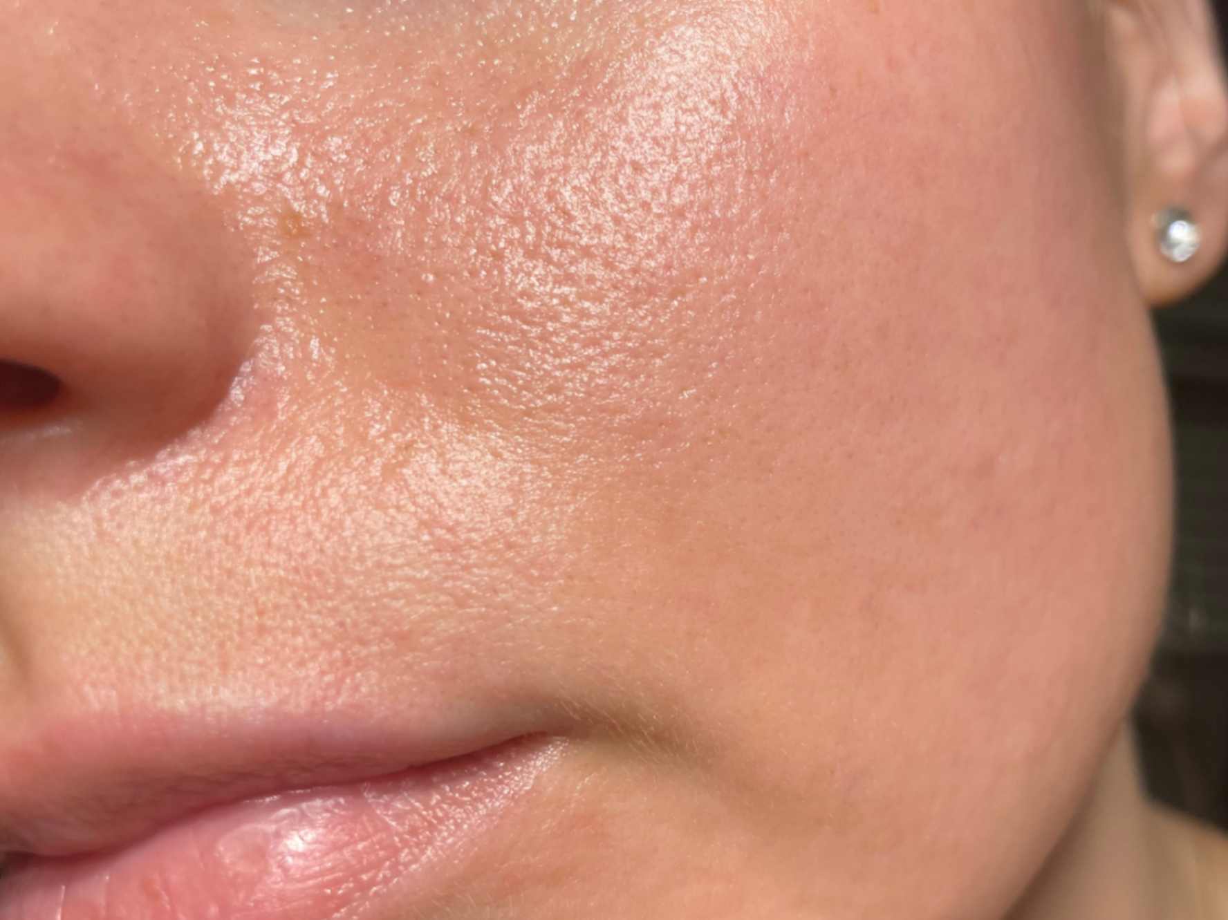 Oily Skin Treatment Oily Skin Treatment