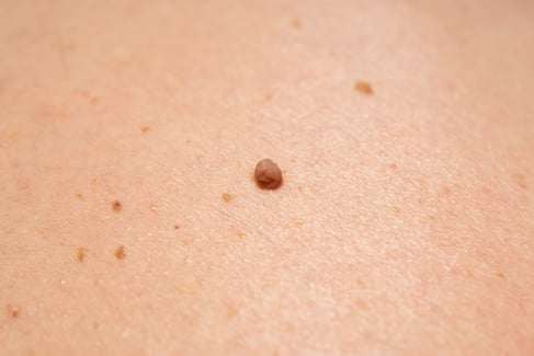 Skin Tag