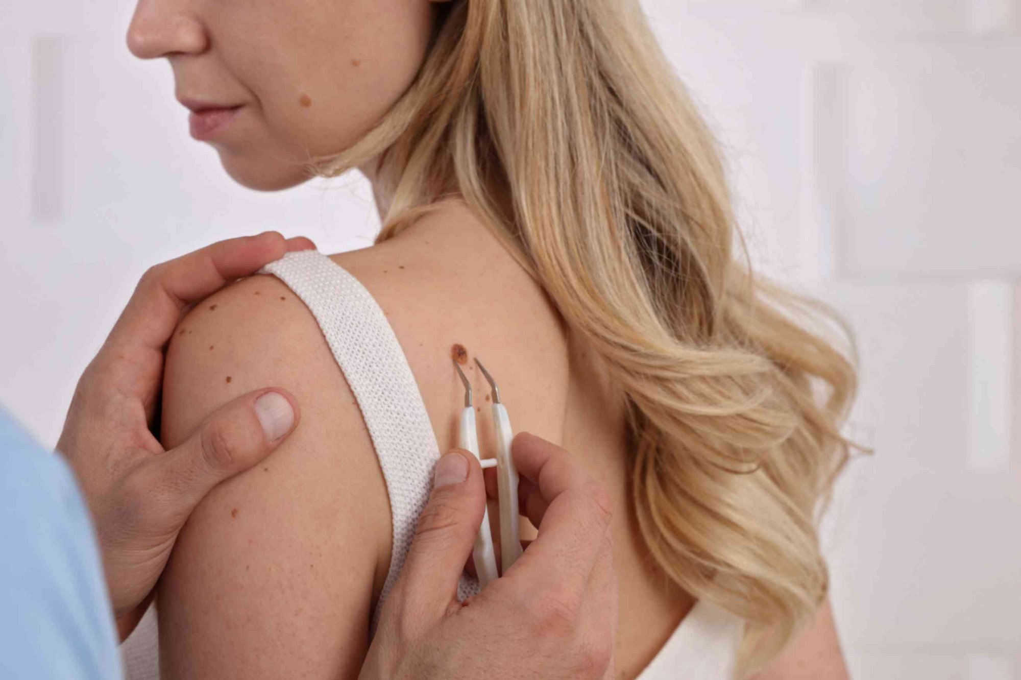 Skin Tags Vancouver