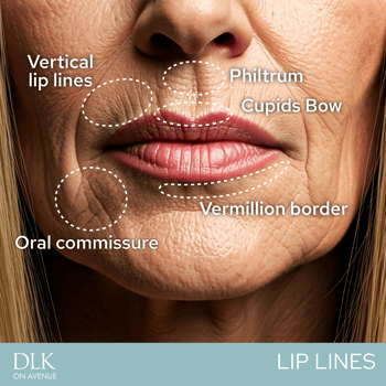 lip lines