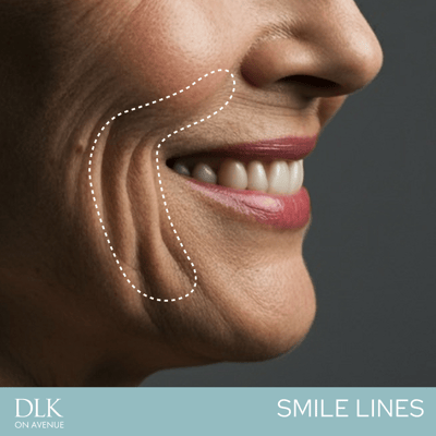 smile lines